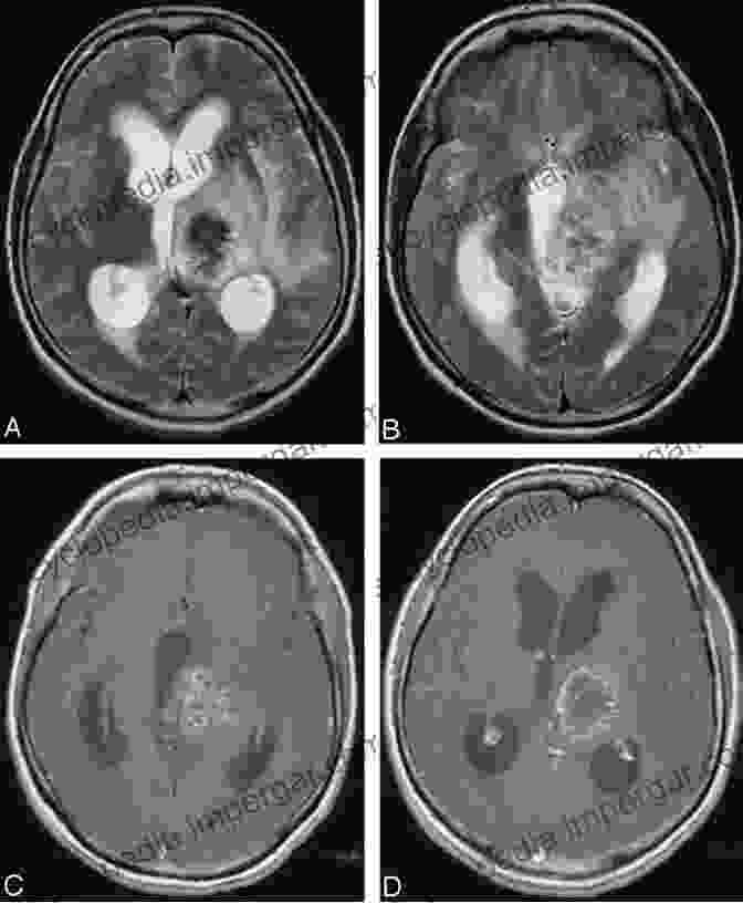 Alveolar Echinococcosis On MRI Scan Radiology Of Parasitic Diseases: A Practical Approach