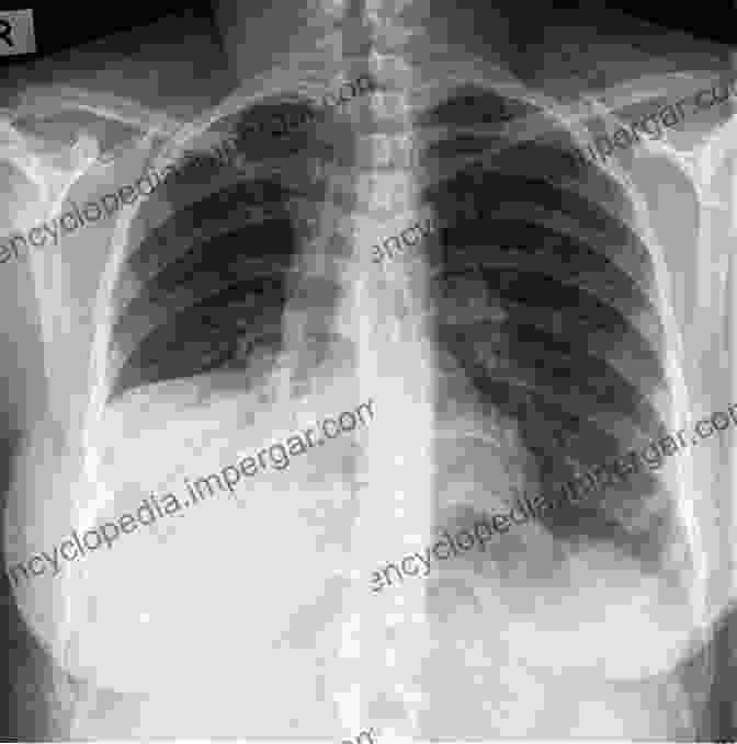 Chest X Ray Of Pneumonia Essentials Of Pathophysiology: Concepts Of Altered Health States