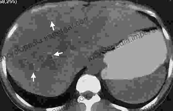 Cystic Echinococcosis On CT Scan Radiology Of Parasitic Diseases: A Practical Approach