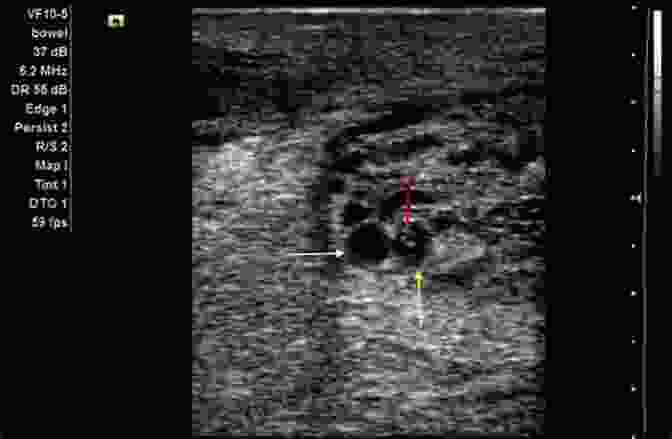 Filariasis On Ultrasound Radiology Of Parasitic Diseases: A Practical Approach