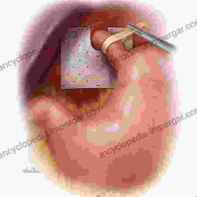 Hernia Repair Surgery With Soft Tissue Modeling Soft Tissue Biomechanical Modeling For Computer Assisted Surgery (Studies In Mechanobiology Tissue Engineering And Biomaterials 11)