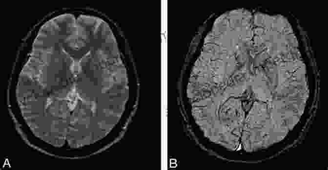 Malaria On CT Scan Radiology Of Parasitic Diseases: A Practical Approach