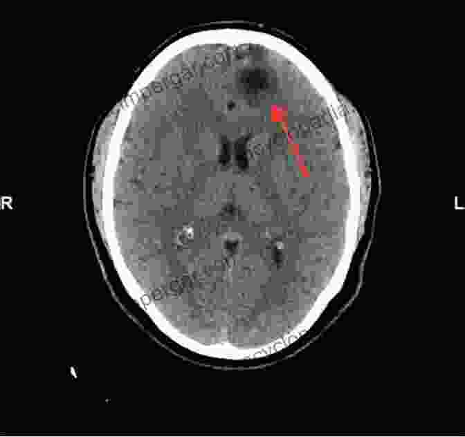 Neurocysticercosis On CT Scan Radiology Of Parasitic Diseases: A Practical Approach