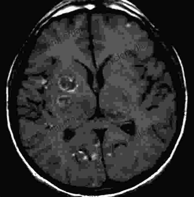 Toxoplasmosis On MRI Scan Radiology Of Parasitic Diseases: A Practical Approach