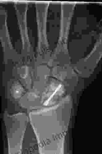 Scaphoid Fractures And Nonunions: A Clinical Casebook